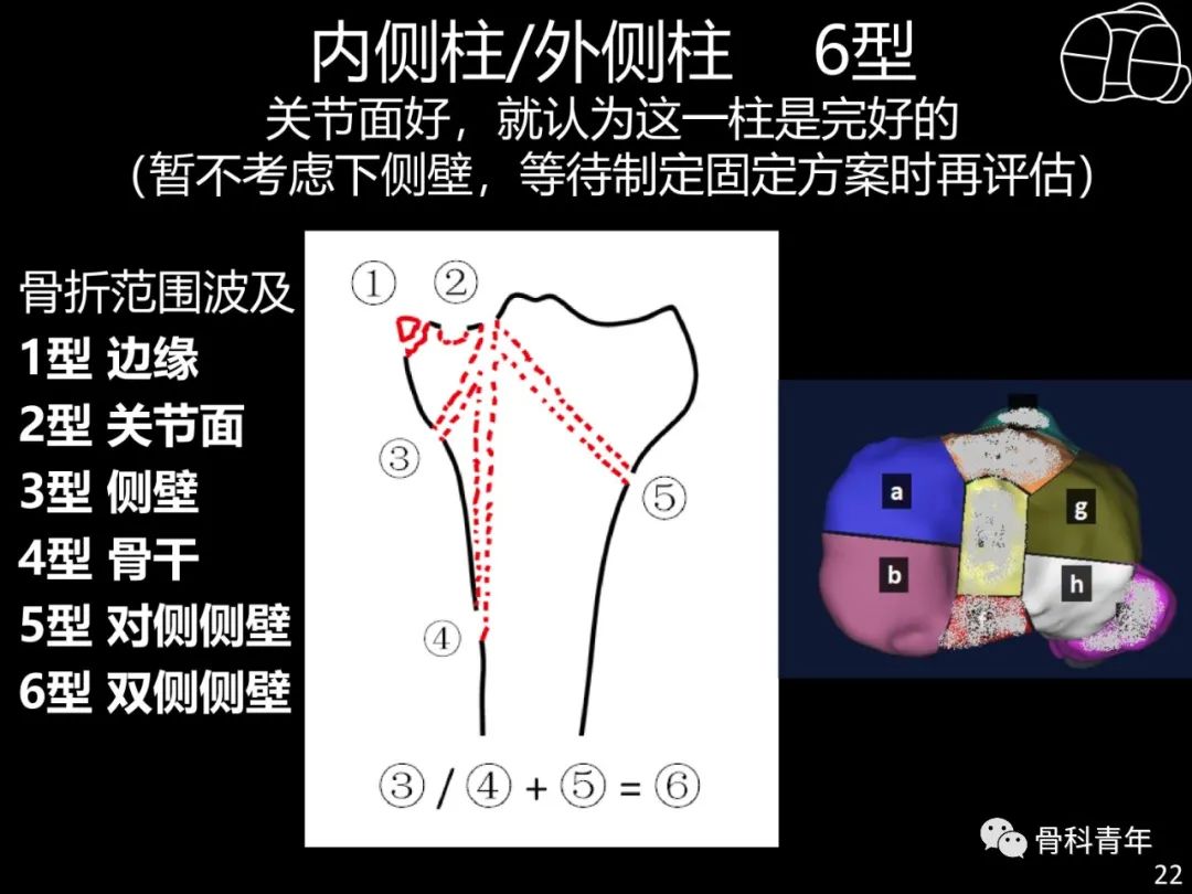 胫骨平台骨折“四柱九区分型”理论介绍