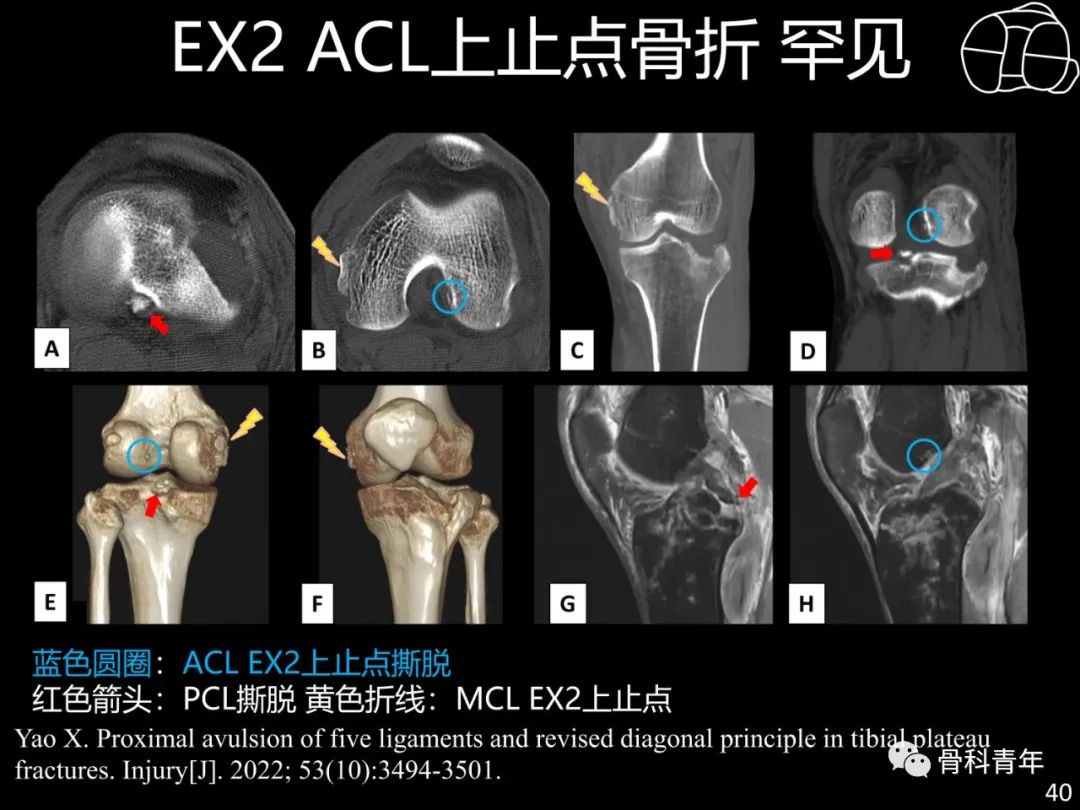 胫骨平台骨折“四柱九区分型”理论介绍