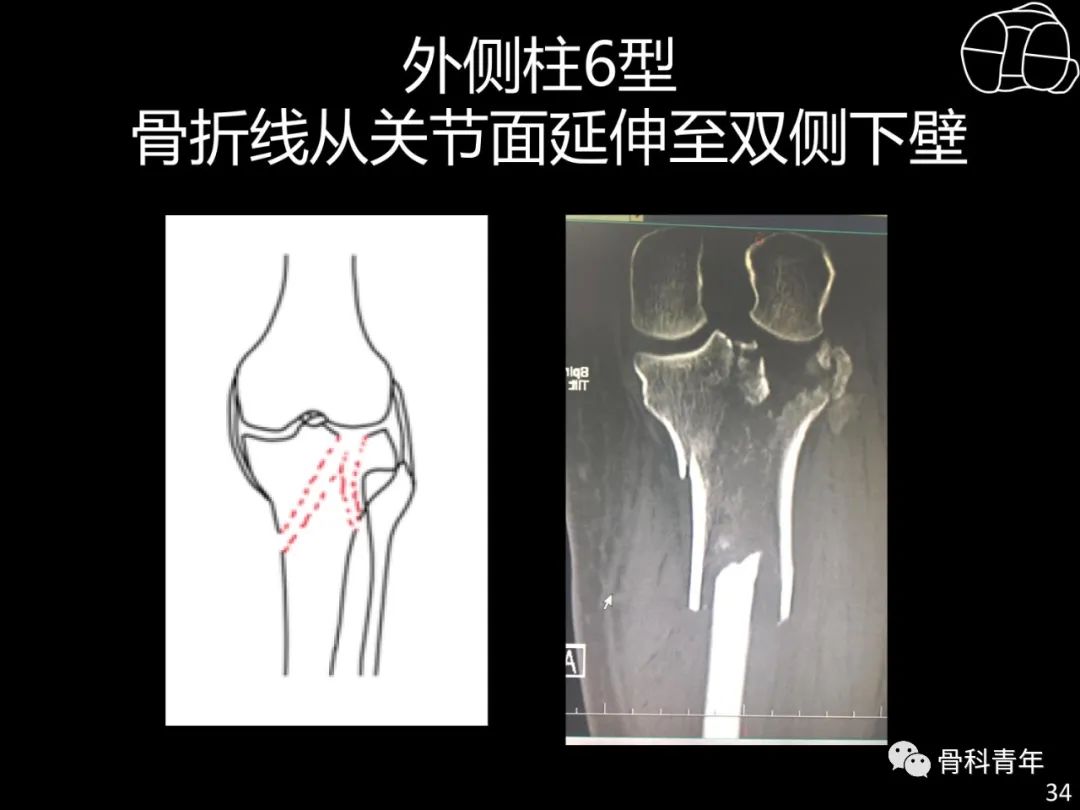 胫骨平台骨折“四柱九区分型”理论介绍