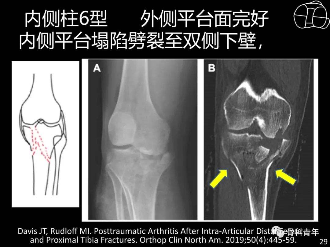 胫骨平台骨折“四柱九区分型”理论介绍