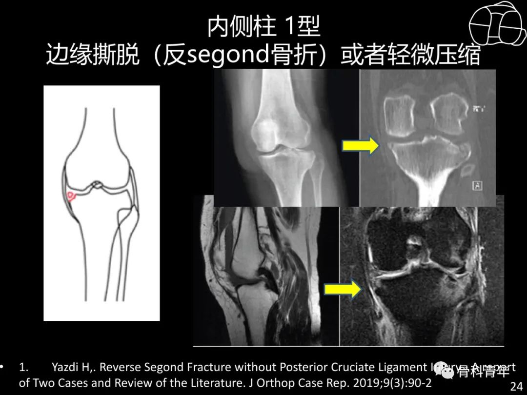 胫骨平台骨折“四柱九区分型”理论介绍