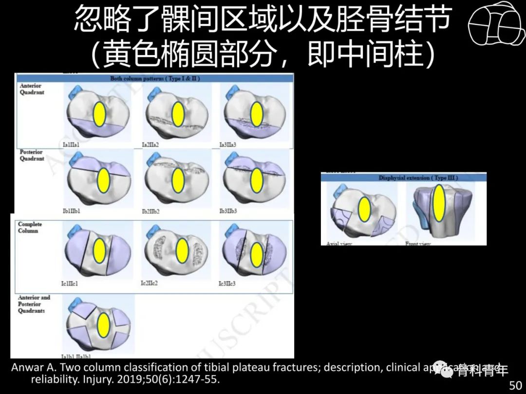 胫骨平台骨折“四柱九区分型”理论介绍