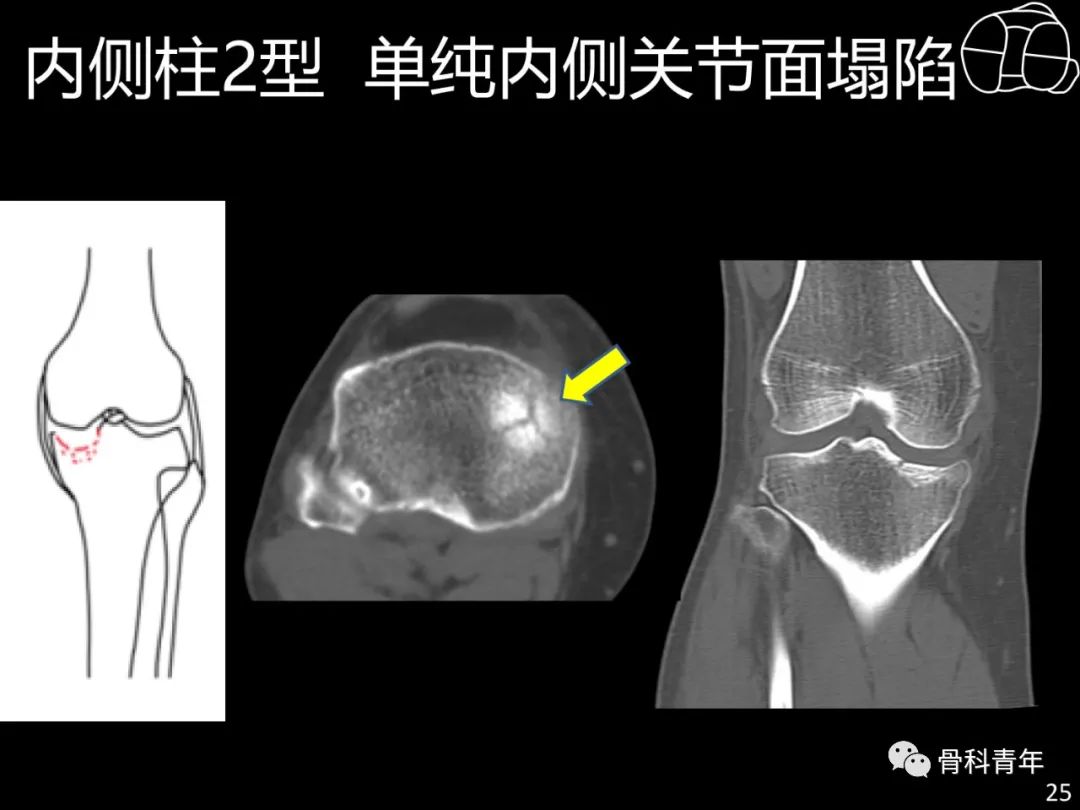 胫骨平台骨折“四柱九区分型”理论介绍