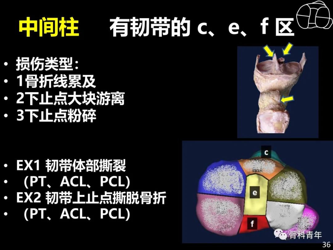 胫骨平台骨折“四柱九区分型”理论介绍