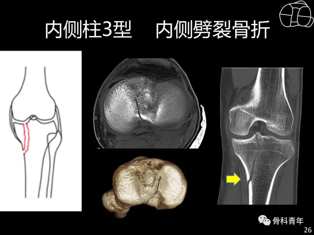 胫骨平台骨折“四柱九区分型”理论介绍