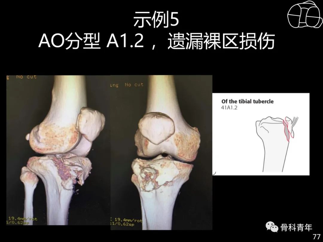 胫骨平台骨折“四柱九区分型”理论介绍