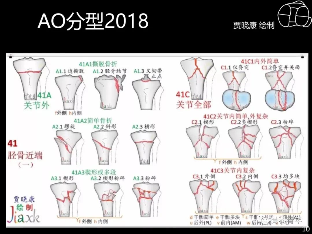 胫骨平台骨折“四柱九区分型”理论介绍