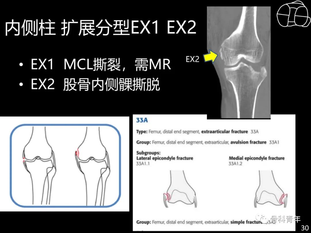 胫骨平台骨折“四柱九区分型”理论介绍