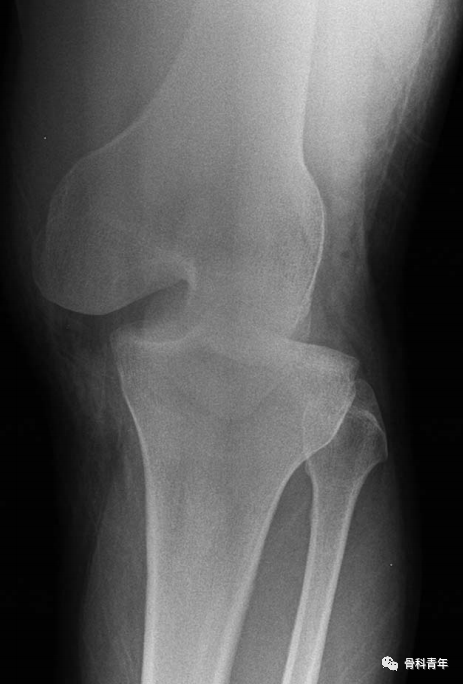 创伤性膝关节脱位的评估、急诊与二期处理