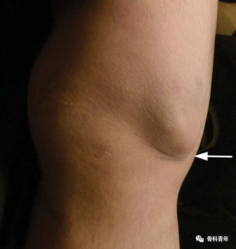 创伤性膝关节脱位的评估、急诊与二期处理