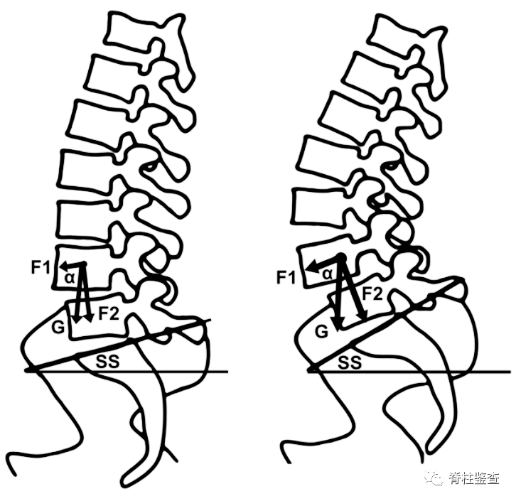 退变性腰椎滑脱腰4椎弓根形态与骶骨倾斜角的关系