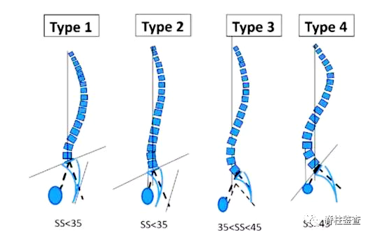 退变性腰椎滑脱腰4椎弓根形态与骶骨倾斜角的关系