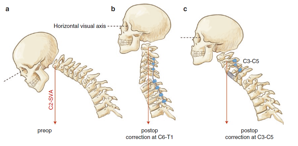 矢状位参数的测量顺序：从骨盆到颈椎