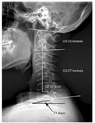 矢状位参数的测量顺序：从骨盆到颈椎