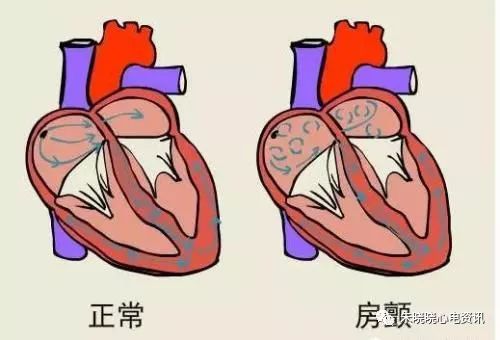 心房颤动与扑动的心电图诊断要点