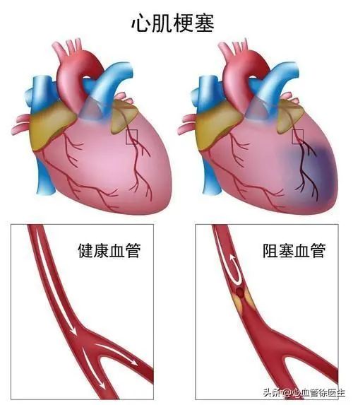 半数以上的心梗发作前都有先兆，千万不要忽视了