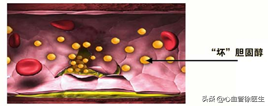 关于血脂的那些事儿……