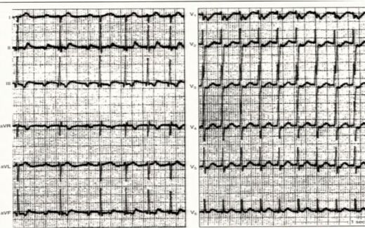 窄QRS波心动过速，鉴别方法面面观