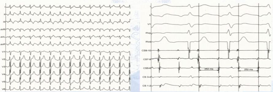 窄QRS波心动过速，鉴别方法面面观