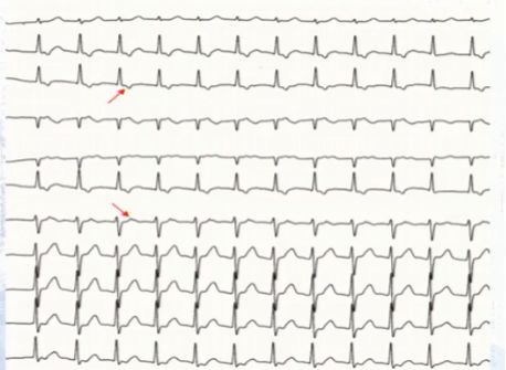 窄QRS波心动过速，鉴别方法面面观