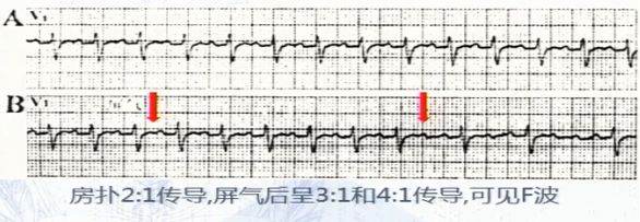 窄QRS波心动过速，鉴别方法面面观