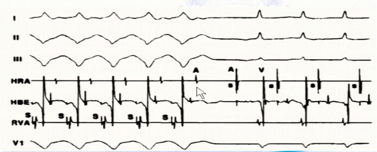 窄QRS波心动过速，鉴别方法面面观