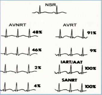窄QRS波心动过速，鉴别方法面面观