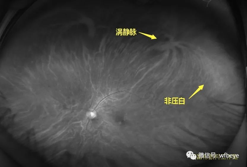 视网膜非压迫变白图片