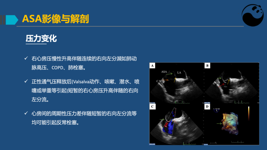 房间隔膨胀瘤：是什么？为什么？怎么办？