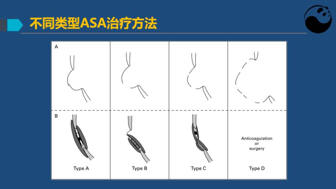 房间隔膨胀瘤：是什么？为什么？怎么办？