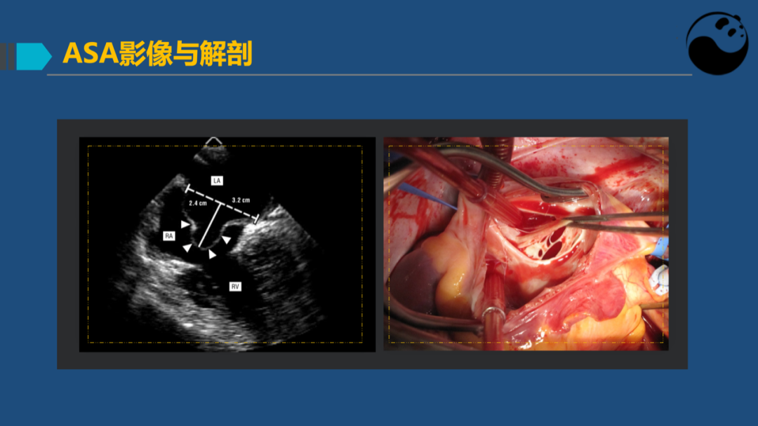 房间隔膨胀瘤：是什么？为什么？怎么办？