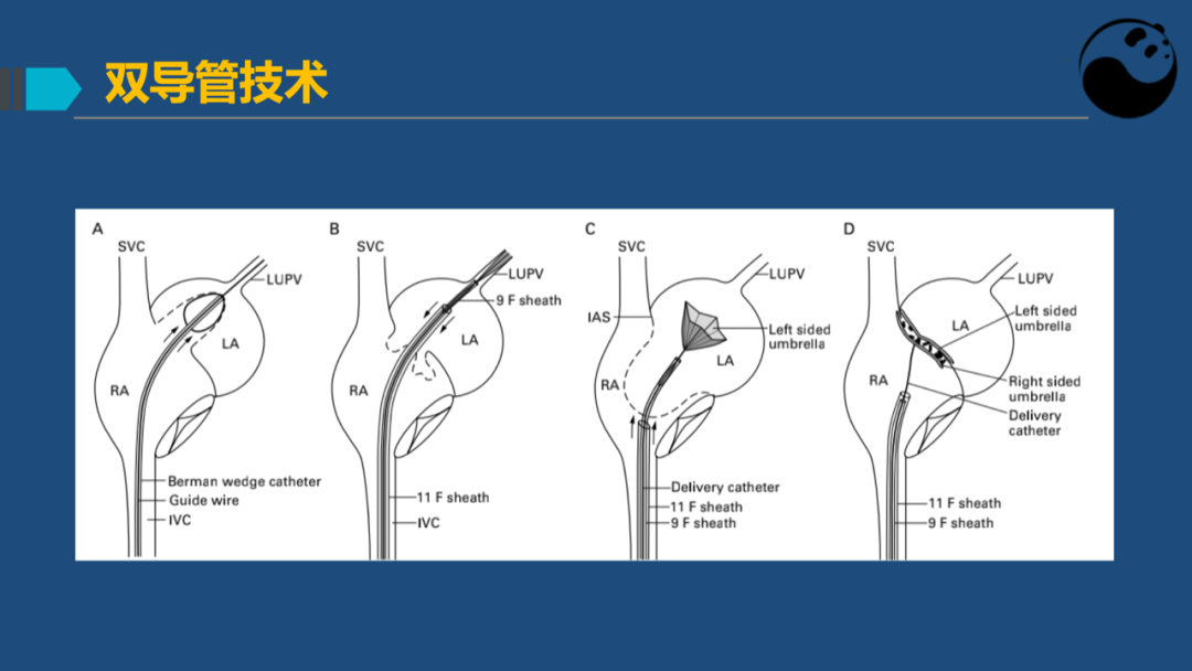 房间隔膨胀瘤：是什么？为什么？怎么办？