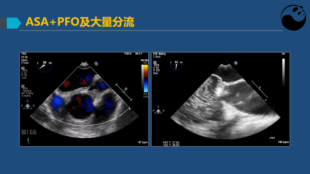 房间隔膨胀瘤：是什么？为什么？怎么办？