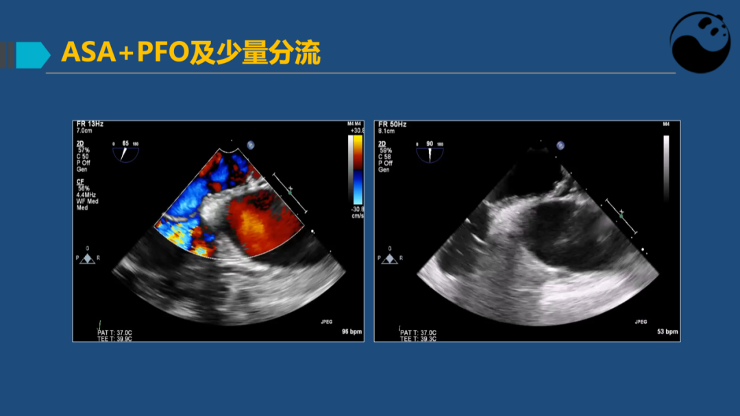 房间隔膨胀瘤：是什么？为什么？怎么办？