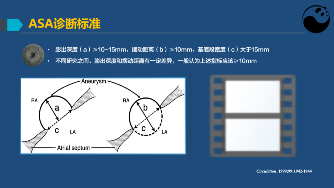 房间隔膨胀瘤：是什么？为什么？怎么办？