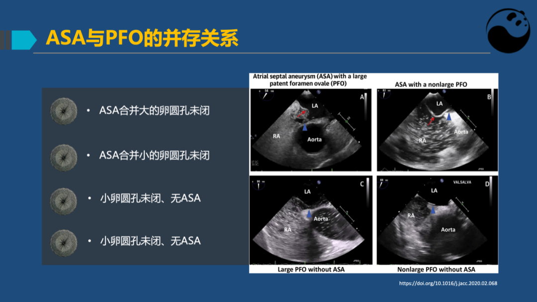 房间隔膨胀瘤：是什么？为什么？怎么办？