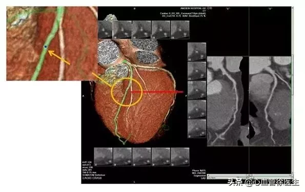 一文get心血管六大检查