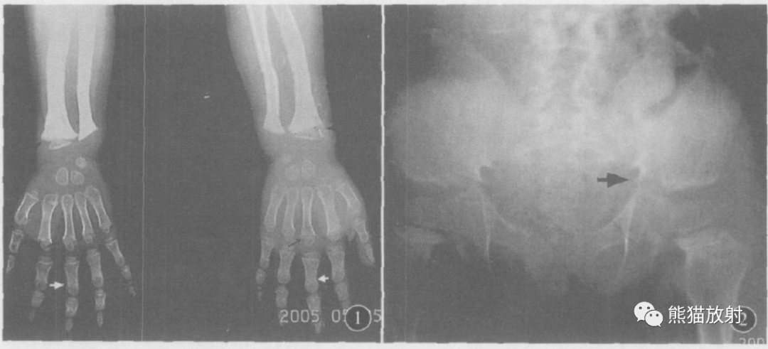 软骨发育不全、脊柱骨骺发育不良、半肢骨骺发育异常的X线诊断要点
