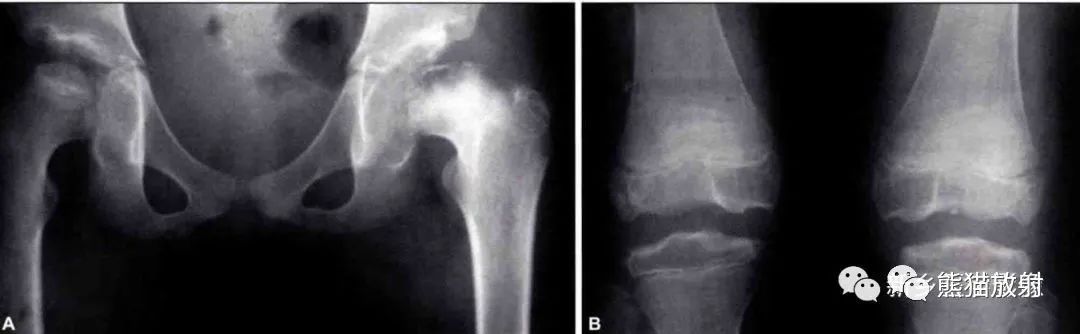 软骨发育不全、脊柱骨骺发育不良、半肢骨骺发育异常的X线诊断要点