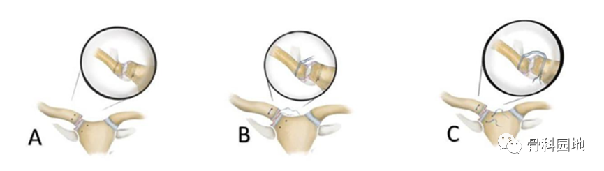 一文了解胸锁关节脱位固定技术