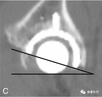 全髋关节置换之股骨优先和联合前倾技术