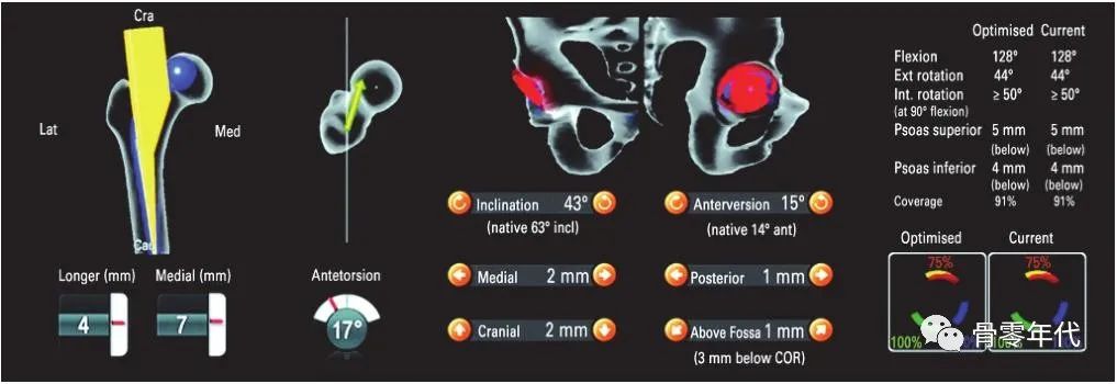 全髋关节置换之股骨优先和联合前倾技术