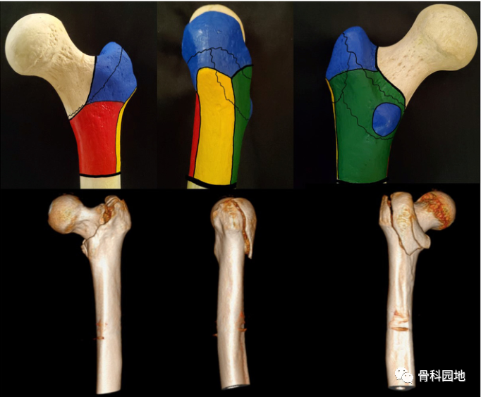 股骨粗隆间骨折基于CT三柱理论分型方法