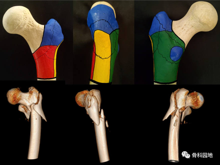 股骨粗隆间骨折基于CT三柱理论分型方法