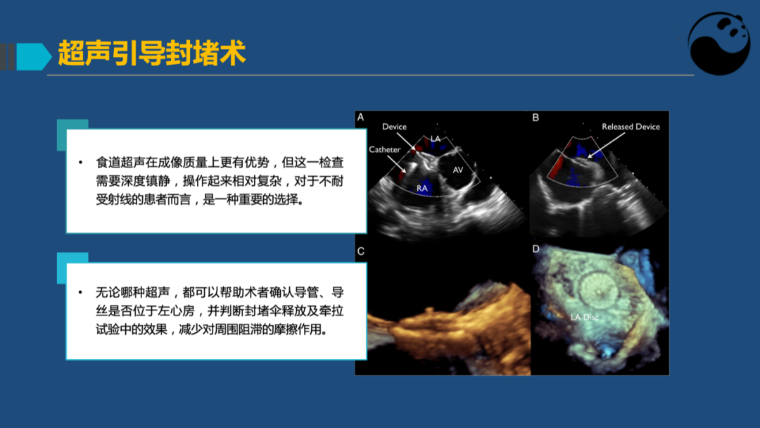 卵圆孔未闭(PFO)介入封堵技巧