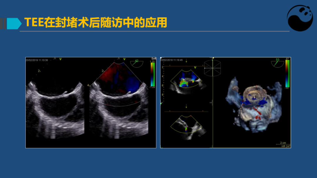 卵圆孔未闭(PFO)介入封堵技巧