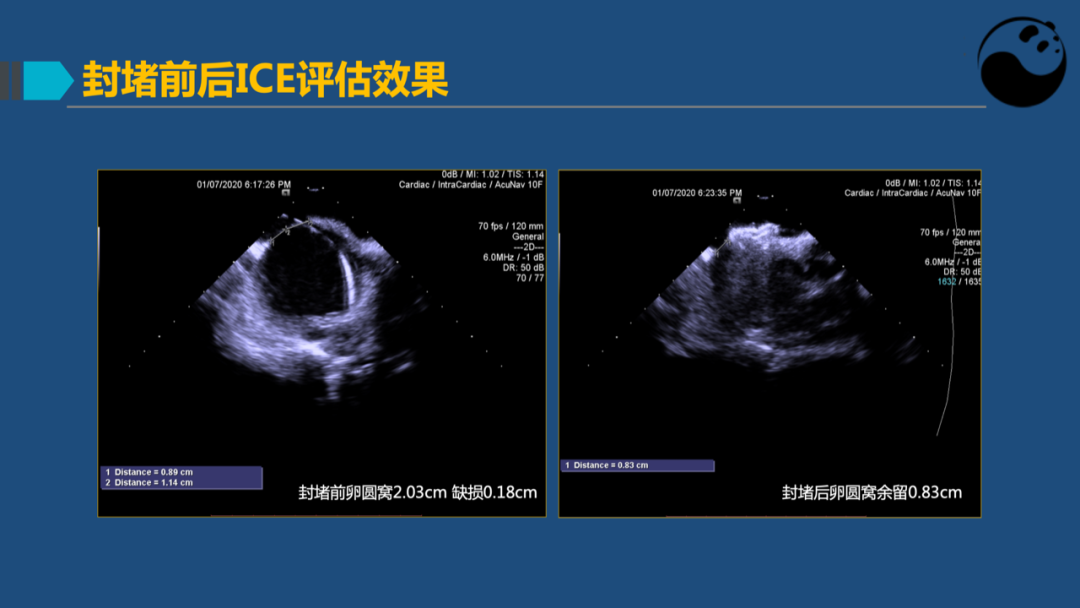 卵圆孔未闭(PFO)介入封堵技巧