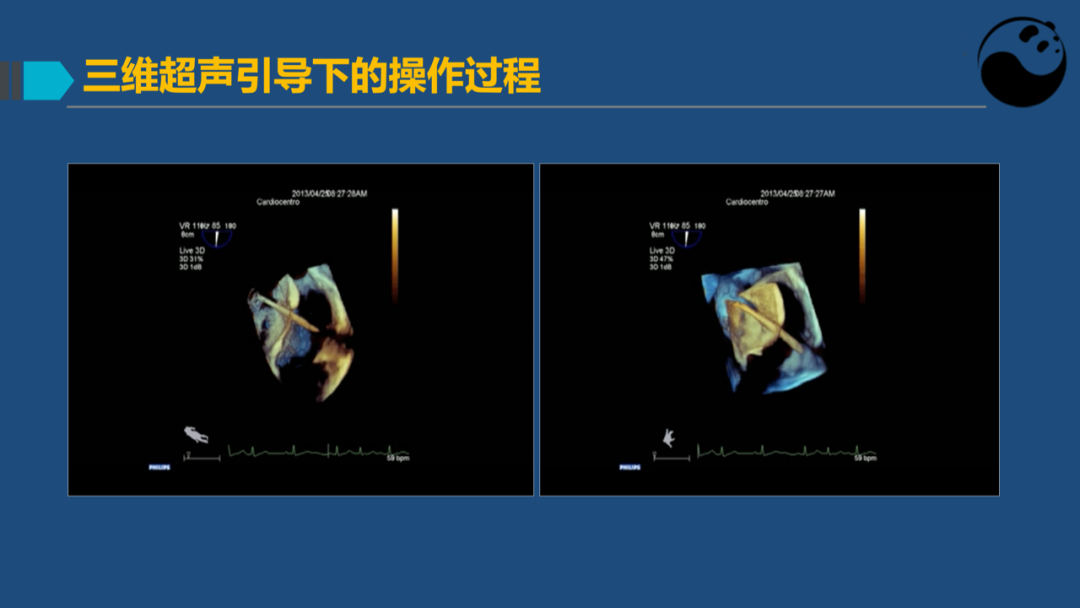 卵圆孔未闭(PFO)介入封堵技巧