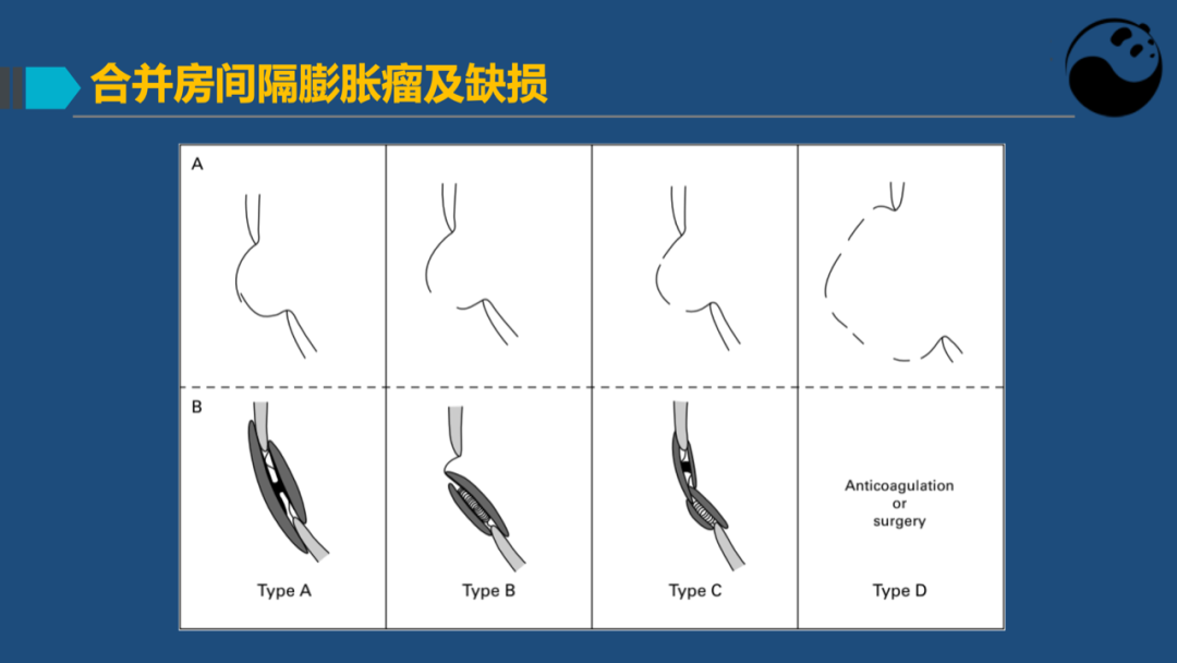 卵圆孔未闭(PFO)介入封堵技巧