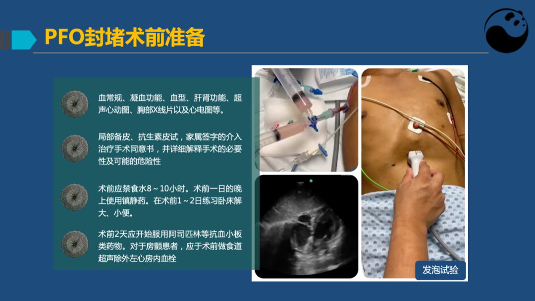 卵圆孔未闭(PFO)介入封堵技巧